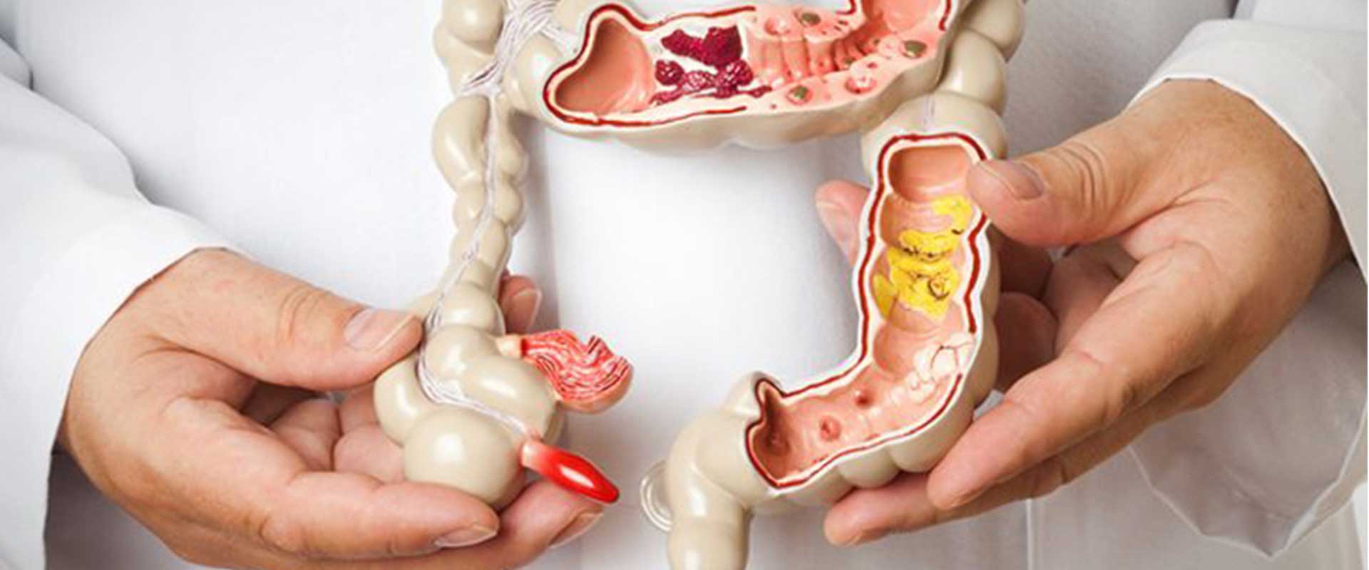 Crohn Hastalığı Belirtileri ve Tedavisi